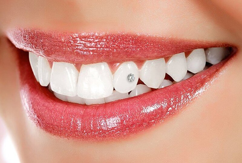 Украшения на зубы Томск Кривоносенко как сделать красивые зубы